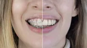 Braces removal