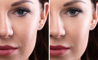 Correction of Wrinkles Correction of Wrinkles