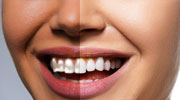 Teeth and Eye Whitening Services