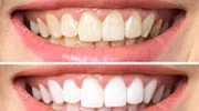 Teeth Whitening