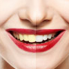 Whitening Teeth