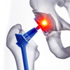 Orthopedic Surgery Animations Orthopedic Surgery Animations